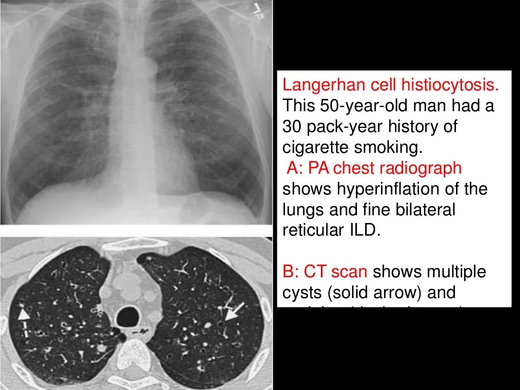 Lung interstitial parenchymal diseases diffuse figure